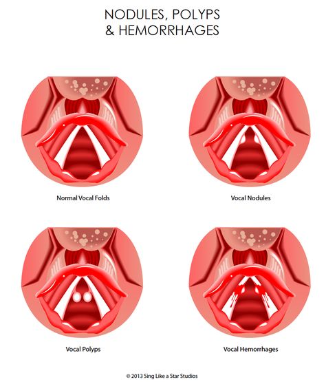 Vocal Dysfunction Due to Trauma | Sing Like a Star Vocal Breathing Exercises, Vocal Folds Anatomy, Vocal Hygiene, Vocals Training, Vocal Health Singing, Vocal Health, Gastric Juice, Reflux Disease, Voice Lesson