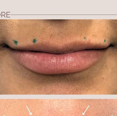 Eliana Norohian, PA-C on Instagram: "Lip flips are magical✨🪄👄  With just 2 units of Botox at each site, we achieved this beautiful lift in the upper lip, creating a more defined and lengthened look.  #fulllips #lipsenhanced #botoxlips #lipflipbotox #lipfliptechnique #lipjourney" Botox Lip Flip Units, Botox Lip Flip, Aesthetic Injector, Lip Flip, Annie Sloan Paint Colors, Botox Lips, Annie Sloan Paints, Full Lips, Upper Lip