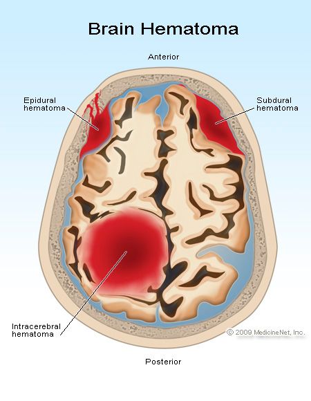 Intracranial Hemorrhage, Radiology Imaging, Brain Surgeon, Nursing Mnemonics, Brain Anatomy, Nursing School Survival, Nursing School Notes, Medical School Studying, Brain Cells