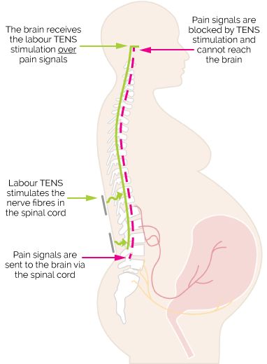 Tens Machine For Labor, Tens Unit Placement, Kegal Exercises, Tens Machine, Pelvic Health, Ten Unit, Bladder Control, Medical Studies, Core Strength