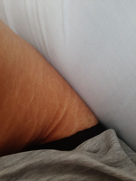 I love the stretch marks on my thighs and hips, I think they are so pretty (: #stretchmarks #bodypositivity  #selflove #naturalbeauty Stretch Mark Aesthetic, Strech Marks Aesthetics, Stretch Mark Positivity, Stretchmarks Beautiful, Lady Aphrodite, Body Appreciation, Unconventional Beauty, Strech Marks, Human Anatomy Reference