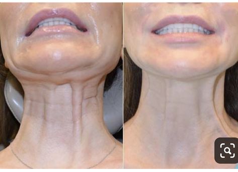 Platysmal Bands, Botox Injection Sites, Injection Sites, Baked Catfish, Catfish Recipe, Botox Injection, Botox Before And After, Botox Lips, Nose Surgery