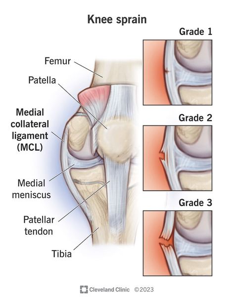 Knee Sprain, Knee Ligaments, Anterior Cruciate Ligament, Ligament Tear, Cruciate Ligament, Bone Fracture, Knee Stretches, Cleveland Clinic, March 2024