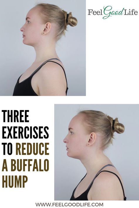 Improve Posture Exercises, Hunched Back, Neck And Shoulder Stretches, Unrealistic Beauty Standards, Shoulder Pain Exercises, Neck Hump, Chin Tuck, Body Inflammation, Forward Head Posture