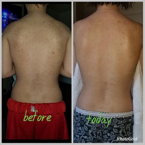 [Before&After] 4 months on Doxycycline  some topicals. Finally feeling comfortable in my own skin Comfortable In My Own Skin, Acne Routine, 4 Months, Hair Skin, Gym Women, Acne, Diet, Womens Shorts, Skin