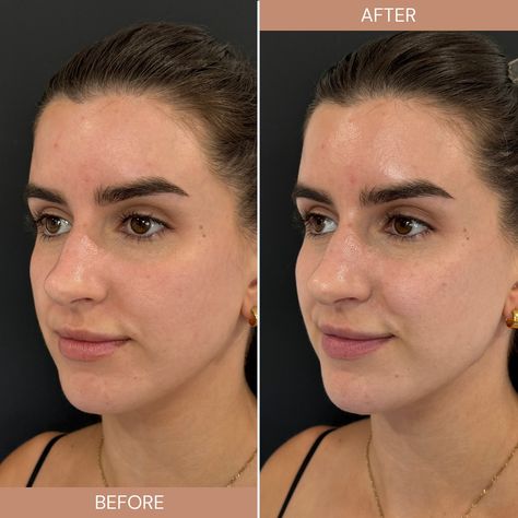 Sometimes filler before & afters aren’t dramatic. 👏🏼 @injector_madison loves educating her clients on the importance of appreciating our own uniqueness and individuality. It’s all about enhancing natural beauty! For this client, Madison used filler to support to the mid face where she was slightly starting to hollow and support anterior jawline and chin. Overall she looks like a refined, lifted and more refreshed version of herself! Curious to learn more about dermal fillers? Schedule a co... Chin Fillers Before After, Chin Filler, Dermal Fillers, Cosmetic Surgery, Surgery, Natural Beauty, Beauty, Quick Saves