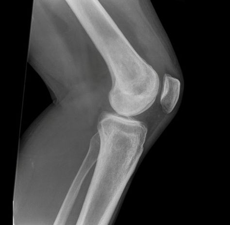 x-ray of left knee. Anatomy Of The Knee, Human Body Unit, Cruciate Ligament, Dramatic Play Preschool, Dramatic Play Centers, Classical Conversations, Kindergarten Science, Community Helpers, Preschool Science