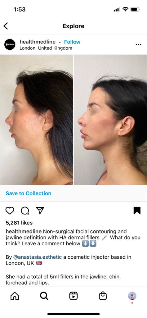 Chin And Cheek Fillers, Alarplasty Before After, Filler Facial Contouring, Facial Contouring Fillers, Plastic Surgery Transformation, Facial Balancing Before And After, Fillers Jawline, Forehead Filler, Chin Fillers Before After Round Face