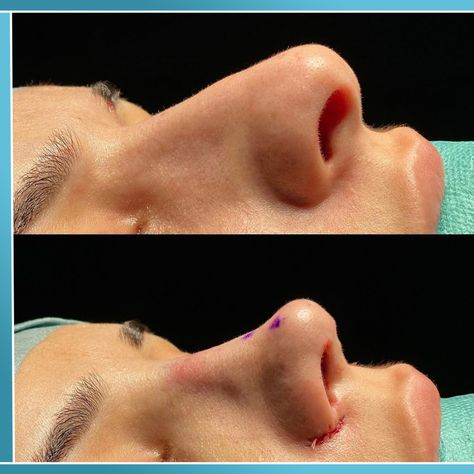 If you are unhappy with the shape of your nose or have trouble breathing And you are looking for a suitable place, so contact one of our consultants and complete your information about rhinoplasty or rhinoplasty and benefit from the experiences of our doctors. Practice_bini_darastanbul #Surgery #nose #nose_operation #nose_beauty_operation #Nose_form #nose_shape #nose_surgery #rhinoplasty #rhinoplasty #Bani #Aesthetics_Bini #Beauty_of_Facial #Practice_Bini_In Ist Nose Operation, Surgery Nose, Nose Surgery, Nose Shapes, Beauty Center, Shape Of You, The Shape, Surgery, Istanbul