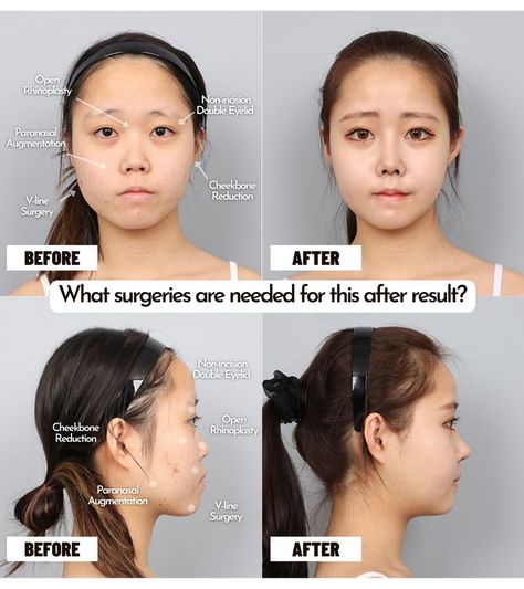 She needs cheekbone reduction, open rhinoplasty, non-incision double eyelid surgery, vline surgery and paranasal augmentation Cheekbone Reduction, V Line Surgery, Double Eyelid, Dermatology, Plastic Surgery, Surgery