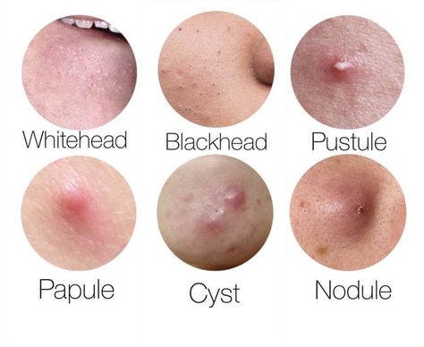 Acne Awareness Month, Acne Awareness, Nodule Acne, Nodular Acne, Redness Pimple, Treating Cystic Acne, Different Types Of Acne, Natural Acne Remedies, Severe Acne