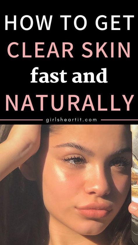 Get Clear Skin Fast, Remove Pimples Overnight, Clear Skin Overnight, Clear Skin Routine, Clear Skin Naturally, Clear Skin Diet, How To Clear Pimples, Clear Skin Fast, Get Clear Skin