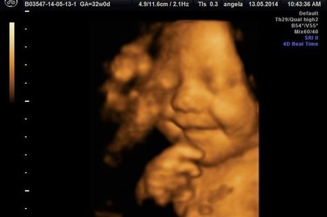 ENGLAND -- An ultrasound image showing a seven month old baby smiling in the womb is drawing amazement as it clearly captures the child's distinct and happy grin. The ultrasound was taken when mother Amy Cregg, 24, went to Babybond Ultrasound Direct in Burnley for a 4D scan at 31 weeks. The increasingly popular form… Ultrasound Pictures, Baby Smiles, Everlasting Life, For God So Loved The World, I John, Over The Moon, Ultrasound, England, The Incredibles