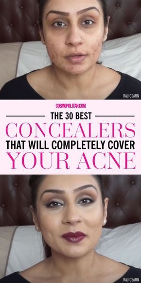 Concealer Products, Best Concealer For Acne, Revolution Skincare, Best Concealers, Acne Makeup, Acne Problem, Best Concealer, Cystic Acne, Acne Remedies