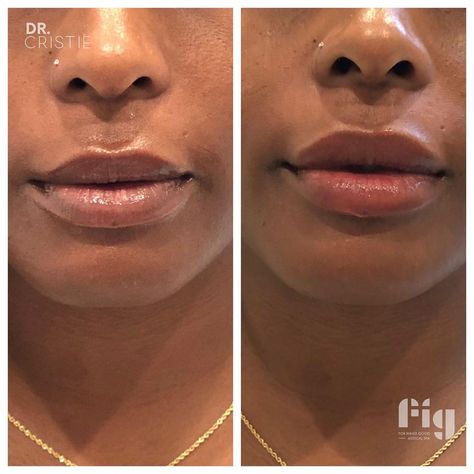 FIG Medical Spa on Instagram: “Dr. Cristie used Juvederm Volbella to give these already gorgeous lips a slight enhancement...💉 ⁣• Don't forget Juvederm is offering a $75…” Medical Spa, Fig, Don't Forget, Spa, Medical, Lips, On Instagram, Instagram