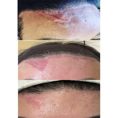 #LiftingColombien#ColombienLifting#美容機器#co2laser#co2laserskinresurfacing#co2lasertreatment#co2fractional_laser#co2fractionallaser#fractionalco2laser#scarremoval#scarremovaltreatment#laserco2#laserco2fraccionado#laserskincare#laserskinresurfacing#laserskinrejuvenation Laser Scar Removal, Scar Removal