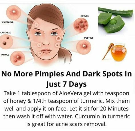 Pimple Solution, Blind Pimple, Pimples Under The Skin, Pimples Overnight, Pimples Remedies, Pimples On Face, Dark Spots On Face, Clear Healthy Skin, Natural Face Skin Care