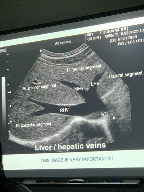 Abdomen Ultrasound Protocol, Diagnostic Medical Sonography Student Notes, Ultrasound Tech Notes, Liver Notes, Sonography Notes, Sonography Student Study, Sonography Humor, Future Sonographer, Ultrasound Technician School