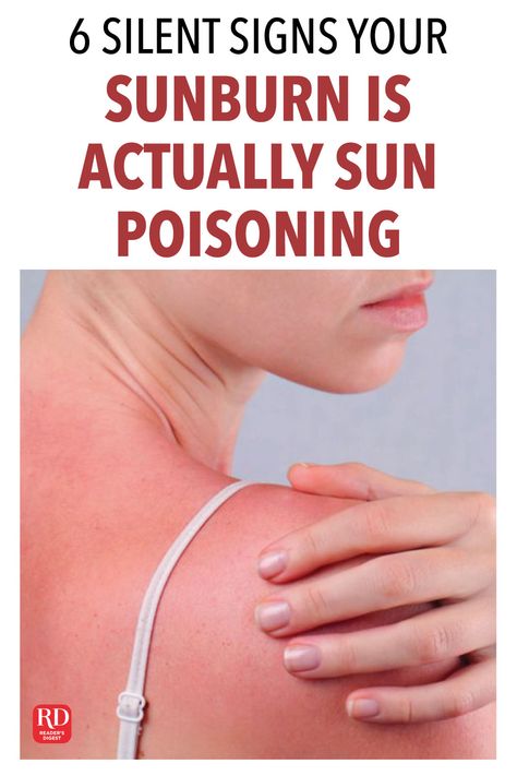 Severe Sunburn Remedies, Best Sunburn Remedy, Severe Sunburn Relief, Apple Cider Vinegar Sunburn, Sun Poisoning Rash, Best Remedy For Sunburn, Really Bad Sunburn, Best For Sunburn, Sunburn Blisters