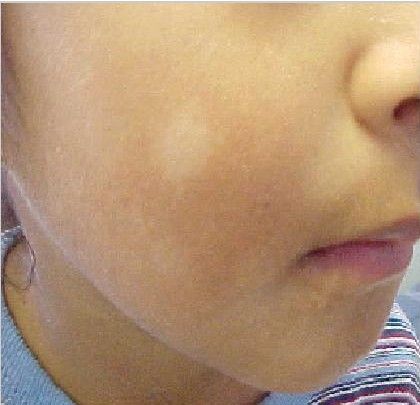 What Are Those White Spots on My Child's Face? Skin Bumps On Face, White Skin Patches, White Skin Spots, Skin Bumps, Dry Skin On Face, Dry Skin Remedies, Brown Spots On Face, Tongue Health, Dry Skin Patches