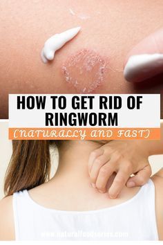 Ring Worm Remedies, Fungal Infection Remedies, Fungal Infection Skin, Natural Remedies For Migraines, Home Remedies For Skin, Grapefruit Seed Extract, Lemongrass Oil, Home Remedies For Hair, Turmeric Tea