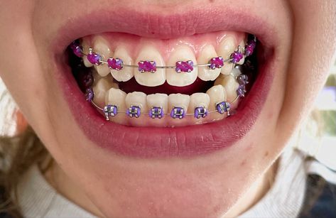 Braces Patterns, Braces Combos, Purple Braces, Braces Colours, Braces Ideas, Shiny Teeth, Kawat Gigi, Braces Smile, After Braces