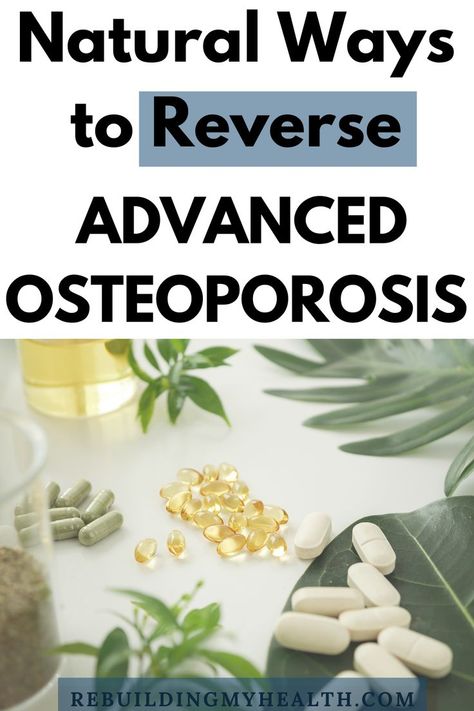 Reverse Osteoporosis Natural, 30 A Florida, Reverse Osteoporosis, Osteoporosis Symptoms, Osteoporosis Diet, Osteoporosis Exercises, Osteoporosis Prevention, Bone Strengthening, Hand Health