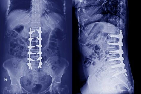 Degenerate Disc Disease, Degenerative Lumbar Disc Disease, Spinal Degeneration, Lumbar Disc, Personal Injury Claims, Degenerative Disease, Spine Health, Awareness Ribbons, Chronic Pain