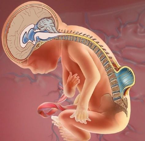 Spina bifida is a birth defect affecting the spinal column. Spina bifida progresses from a cleft, or splitlike opening, in the back part of the backbones (the spinal vertebrae). In more severe cases, it involves the spinal cord. Spina bifida is the most common of a group of birth defects known as neural tube defects, which affect the central nervous system. It can impair your toddler’s brain, spine, spinal cord, and meninges (tissues covering and protecting the brain and the spinal cord). Spina Bifida Awareness, Spinal Fluid, Spinal Column, Spina Bifida, Spinal Nerve, Social Stigma, Womens Health Care, Poor Nutrition, High Fever