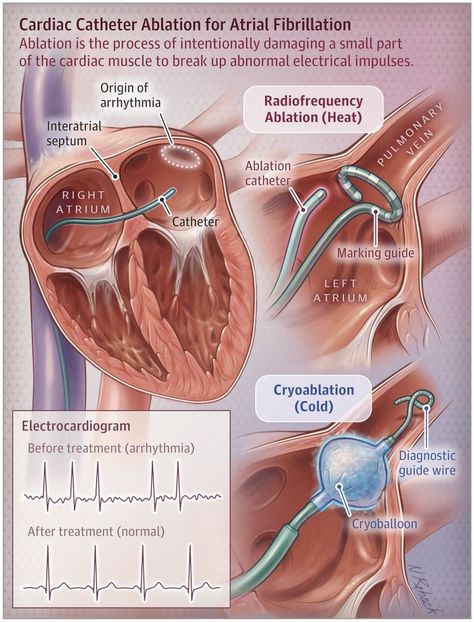 body systems Cath Lab Nursing, Heart Rhythm, Cardiac Nursing, Nursing School Survival, Critical Care Nursing, Atrial Fibrillation, Nursing School Studying, Nursing School Tips, Medical School Studying