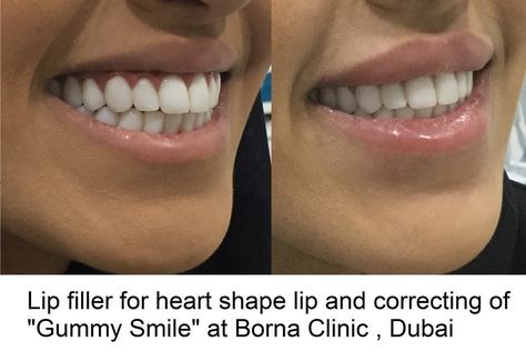 Gummy Smile Correcting, Lip Filler, Dubai Lip Filler Smile, Gummy Smile Correction, Restylane Lips, Beauty Maintenance, Hyaluronic Acid Lips, Heart Shaped Lips, Gummy Smile, Lip Filler, Lip Enhancement