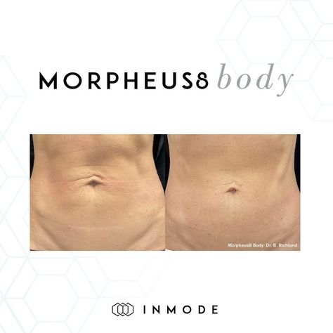 Some gorgeous before & after transformations using Morpheus8 to say goodbye to wrinkles, acne scars, and cellulite! Sign-up today! 😍 DM Us or Call 📲 813.990.9573 #inmode #medspa #tampamedspa #iglowaesthetics #morpheus8 #radiofrequency #microneedling Morpheus8 Before And After, Morpheus 8 Before And After, Radiofrequency Microneedling, Morpheus 8, Before And After Transformation, Beauty Clinic, 2025 Vision, To Say Goodbye, Med Spa