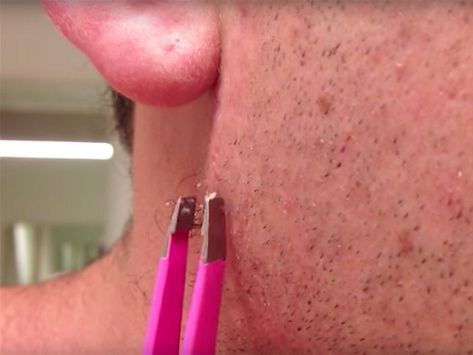 VIDEO: the Most-Watched Ingrown Hair Removal on YouTube - Business Insider Ingrown Hair Removal Videos, Clear Flawless Skin, Easy Sugar Scrub, Ingrown Hair Removal, Sugaring Hair Removal, Best Hair Removal Products, Medical Videos, Youtube Business, Acne Studio