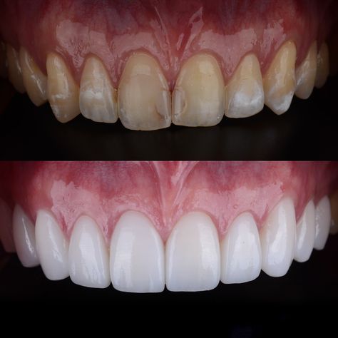 All about Smile Composite Teeth, Composite Bonding, About Smile, Composite Veneers, Hollywood Smile, Veneers Teeth, Teeth Dentist, Turkey Istanbul, Dental Practice