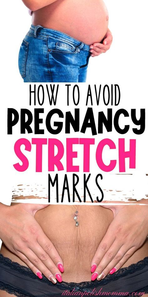 A pregnant woman with no stretch marks on her belly bump and a woman after she had her baby with stretch marks on her belly. Stretch Mark Cream Pregnancy, How To Fade, Stretch Mark Cream, Stretch Mark, Pregnancy Journey, Pregnancy Symptoms, Pregnancy Care, Pregnancy Stages, First Pregnancy