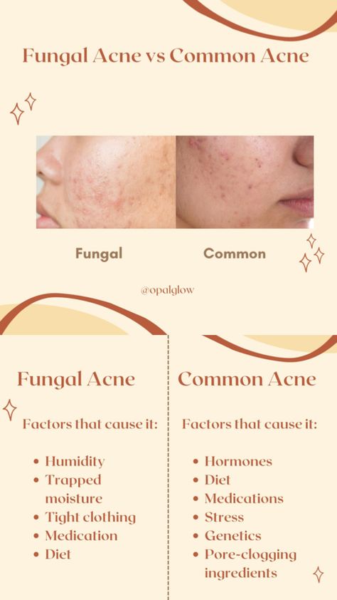 Whilst both may look the same, they are different…  Causes for fungal acne:  •Humidity •Trapped moisture •Tight clothing •Medication •Diet   Causes for common acne:  •Hormones •Diet •Medications •Stress •Genetics •Pore-clogging ingredients  #cogcmkg2024 #skincare #opalglow Hormone Diet, Acne Diet, Fungal Acne, Tights Outfit, Moisturizer, Medical, Acne, Skin Care, Diet