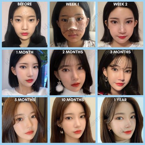 Surgeries she had: 🌺 Square jaw surgery 🌺 Cheekbone reduction 🌺 Incisional double eyelid surgery 🌺 Barbie line rhinoplasty #idhospitalkorea #koreanplasticsurgery #plasticsurgery #plasticsurgerykorea #besttransformation #vline #vlinesurgery #vshapeface #facialcontouring #cheekbonereduction #rhinoplasty #nosesurgery #nosejob #rhinoplastysurgeon #koreanrhinoplastysurgeon #canthoplastysurgery #doubleyelidsurgery Vline Surgery Before And After, Korean Nose Job, South Korean Plastic Surgery, Cheekbone Reduction, Korean Nose, Beauty Surgery, Square Jaw, V Line Surgery, Plastic Surgery Korea