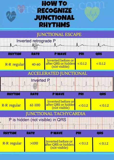 How to recognize junctional rhythms. MedicTests.com Junctional Rhythm, Telemetry Nursing, Cardiac Rehab, Cardiology Nursing, Paramedic School, Nursing Information, Cardiac Nurse, Nursing Mnemonics, Cardiac Nursing