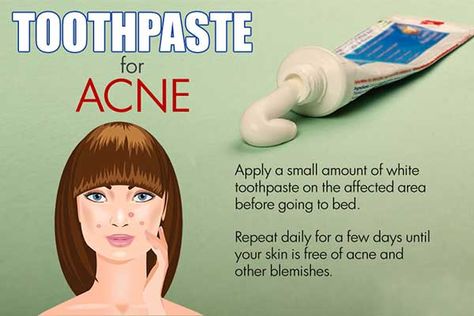 #tooothpaste can solve your #acne problem Toothpaste For Acne, Cystic Acne Remedies, Korean Beauty Secrets, Natural Acne Remedies, Natural Acne, Home Remedies For Acne, Cystic Acne, Beauty Remedies, Acne Remedies