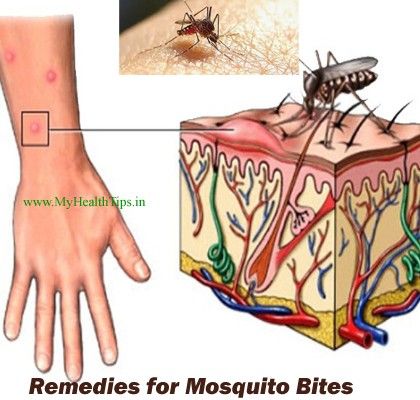 Mosquito Bite Allergy, Mosquito Bite Itch, Remedies For Mosquito Bites, Bug Bites Remedies, Mosquito Bites, Mosquito Bite, Bug Bites, Homemade Remedies, Diy Health