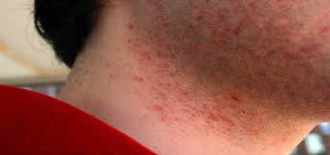 Skin Irritation Preventing Razor Burn, Razor Burn Remedies, Razor Bumps Remedy, Neck Acne, Burn Remedy, Shaving Bumps, Razor Burn, Razor Bumps, Woman Shaving