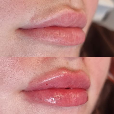 Lip Filler 0.5ml, Bad Lip Filler, 0.5ml Lip Filler Before And After, Lip Fillers Before And After 1ml, 0.5 Ml Lip Filler Before And After, 1ml Lip Filler, Russian Lips, Spa Aesthetic, Revolution Beauty