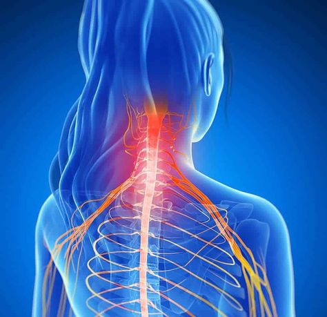 How to Sleep With Pinched Nerve in Neck, Back, and Shoulder? Pinched Nerve In Neck, Cervical Disc, Neck And Shoulder Muscles, Cervical Traction, Pinched Nerve, Neck Pain Relief, Sciatic Nerve Pain, Sciatica Pain, Neck And Back Pain