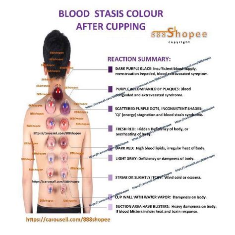 Cupping Therapy Chart, Cupping Points, Acupressure Points Chart, Anatomy Trains, Acupuncture Charts, Body Cupping, Massage School, Quantum Healing Hypnosis, Body Chart