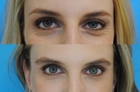 Crows Feet Botox Before After, Botox Before And After, Botox Fillers, Botox Injections, Crows, Skin Treatments, Natural Remedies, Take That, California