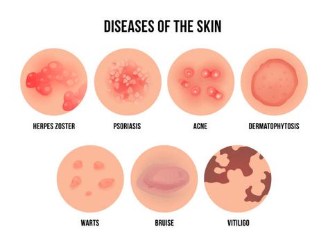 Skin Rashes Pictures, Skin Disease Pictures, Types Of Skin Rashes, Skin Logo, Health Icon, Natural Antibiotics, Healthy Liver, Skin Disorders, Skin Diseases