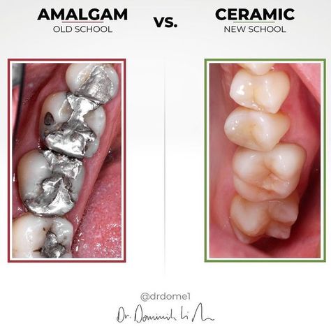 Dr. Dominik Nischwitz on Instagram: "AMALGAM “Toxic waste from last century” ☝🏽Besides obviously being a very unaesthetic filling material, AMALGAM fillings or “silver fillings” simply are not the healthiest choice. 👉🏽Amalgam does contain 50% mercury which is the most toxic, non-radioactive element know to men. In the dental office we need to remove this material as “highly-toxic waste”. 🔥The mercury is NOT tightly bound in the filling. About 2-3mcg of mercury vapor will be release daily thr Amalgam Fillings, Dental Materials, Holistic Dentistry, Thyroid Healing, Dental Fillings, Toxic Waste, Implant Dentistry, Acidic Foods, Dental Cleaning