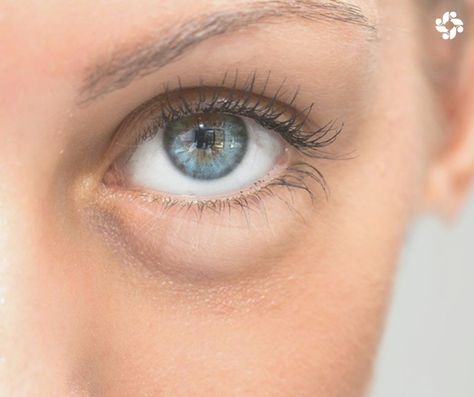 Eye bags appear when the skin starts to sag, and fat around the area around the eye can relocate into the area below your eyes. This area can also look ‘baggy’ thanks to accumulated fluid. #SkinRenewalSA #2OceansVibe #EyeBags #eyes #skin #RenewalInstitute Baggy Eyes, Remove Dark Circles, Facial Peel, Brow Lift, Dark Under Eye, Dark Circles Under Eyes, Prevent Aging, Undereye Circles, Dermal Fillers