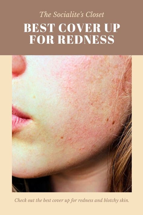 Perfect Cover Up For Redness and Blotchiness #Rosacea Foundation For Redness, How To Cover Redness On Face, Redness On Face, Green Concealer, Allergy Eyes, Sensitive Skin Care Routine, Pale Skin Makeup, Pale Makeup, Makeup Coverage