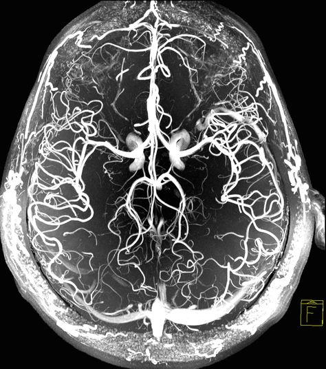 Blood vessels of the human brain shown via Magnetic Resonance Angiography at 7T #MRI Image by Dr. Jon Polimeni, #MGH Brain Neurons Art, Neurosurgery Art, Neurons Art, Brain Medicine, Brain Neurons, Brain Images, Brain Scan, Brain Art, Magnetic Resonance